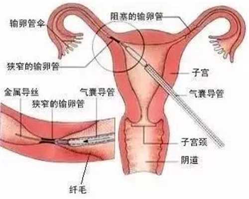 上海助孕包性别_上海借腹怀胎机构
